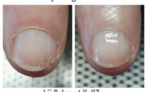 Beschadigde natuurlijke nagels snel en vakkundig hersteld